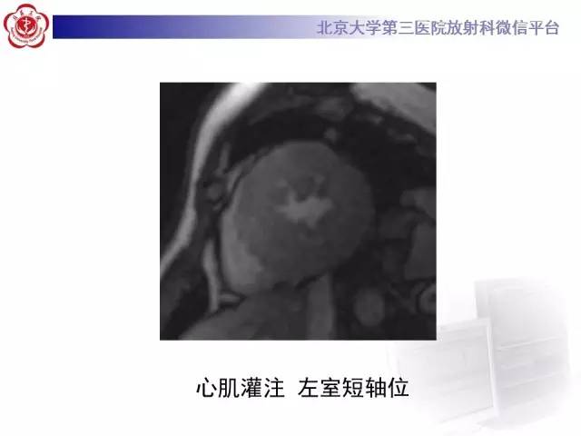 【病例】肥厚性心肌病1例MR影像表现