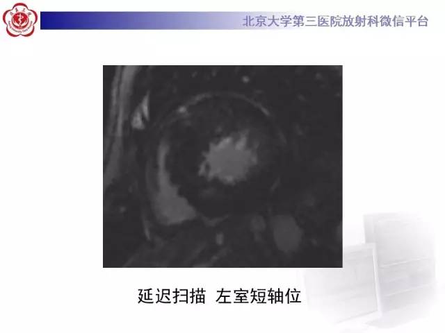 【病例】肥厚性心肌病1例MR影像表现