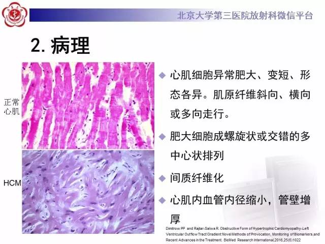 【病例】肥厚性心肌病1例MR影像表现