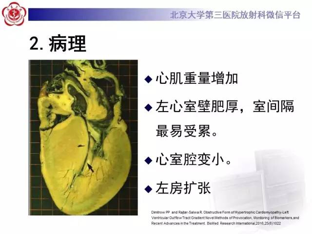【病例】肥厚性心肌病1例MR影像表现