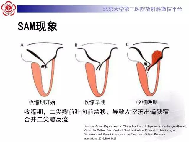 【病例】肥厚性心肌病1例MR影像表现