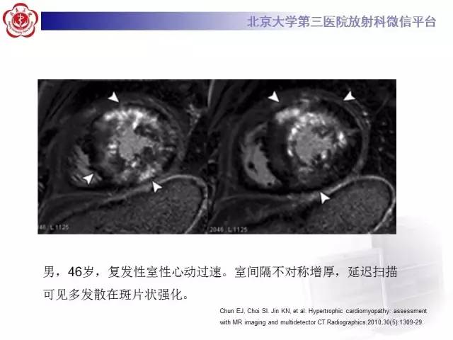 【病例】肥厚性心肌病1例MR影像表现