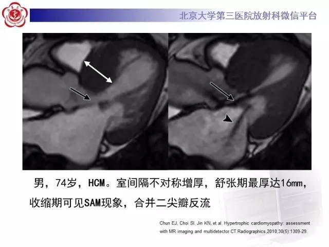 【病例】肥厚性心肌病1例MR影像表现