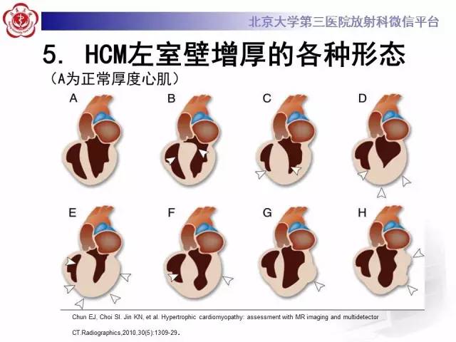【病例】肥厚性心肌病1例MR影像表现