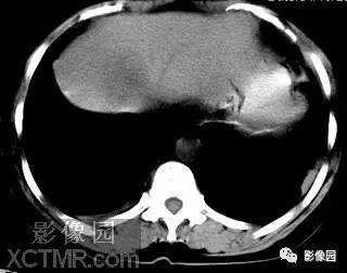 【病例】肝脓肿1例MR影像表现 【病例】肝脓肿1例MR影像表现