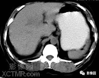 【病例】肝脓肿1例MR影像表现 【病例】肝脓肿1例MR影像表现