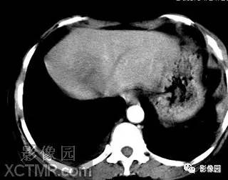 【病例】肝脓肿1例MR影像表现 【病例】肝脓肿1例MR影像表现