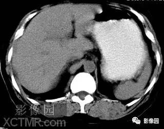 【病例】肝脓肿1例MR影像表现 【病例】肝脓肿1例MR影像表现