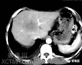 【病例】肝脓肿1例MR影像表现 【病例】肝脓肿1例MR影像表现