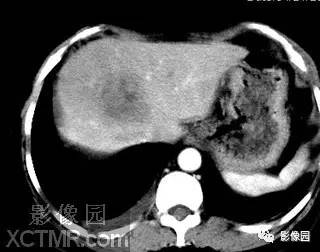 【病例】肝脓肿1例MR影像表现