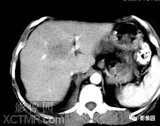 【病例】肝脓肿1例MR影像表现 【病例】肝脓肿1例MR影像表现