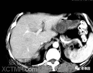 【病例】肝脓肿1例MR影像表现 【病例】肝脓肿1例MR影像表现