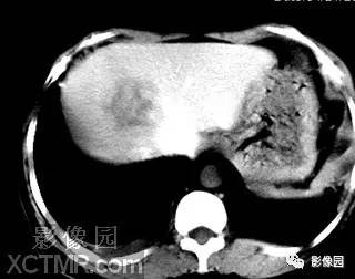 【病例】肝脓肿1例MR影像表现 【病例】肝脓肿1例MR影像表现