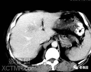 【病例】肝脓肿1例MR影像表现 【病例】肝脓肿1例MR影像表现