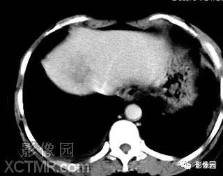【病例】肝脓肿1例MR影像表现 【病例】肝脓肿1例MR影像表现