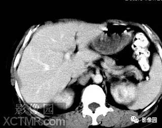 【病例】肝脓肿1例MR影像表现 【病例】肝脓肿1例MR影像表现