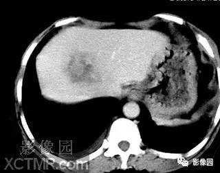 【病例】肝脓肿1例MR影像表现 【病例】肝脓肿1例MR影像表现