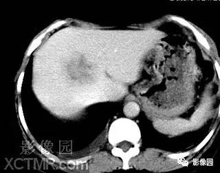 【病例】肝脓肿1例MR影像表现 【病例】肝脓肿1例MR影像表现