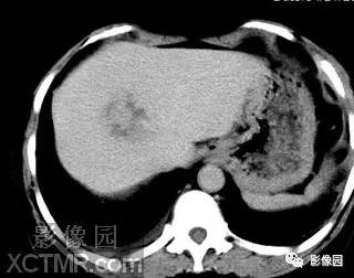 【病例】肝脓肿1例MR影像表现 【病例】肝脓肿1例MR影像表现