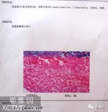 【病例】肝脓肿1例MR影像表现 【病例】肝脓肿1例MR影像表现