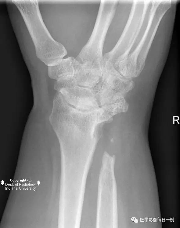 【病例】腕关节类风湿性关节炎1例X线影像表现 【病例】腕关节类风湿性关节炎1例X线影像表现