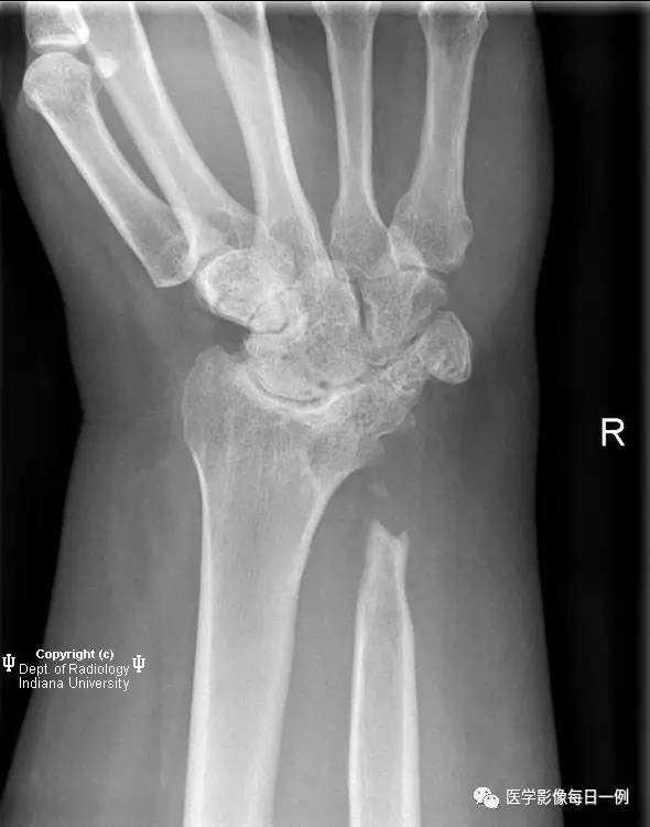 【病例】腕关节类风湿性关节炎1例X线影像表现