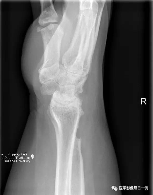 【病例】腕关节类风湿性关节炎1例X线影像表现 【病例】腕关节类风湿性关节炎1例X线影像表现