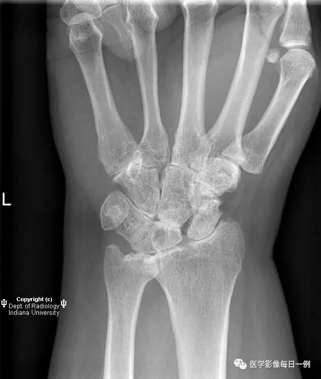 【病例】腕关节类风湿性关节炎1例X线影像表现 【病例】腕关节类风湿性关节炎1例X线影像表现