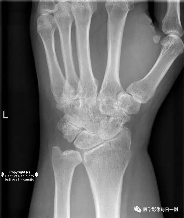 【病例】腕关节类风湿性关节炎1例X线影像表现 【病例】腕关节类风湿性关节炎1例X线影像表现