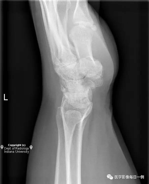【病例】腕关节类风湿性关节炎1例X线影像表现 【病例】腕关节类风湿性关节炎1例X线影像表现