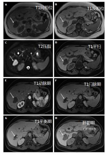 快速入门手册——肝脏占位MRI 快速入门手册——肝脏占位MRI