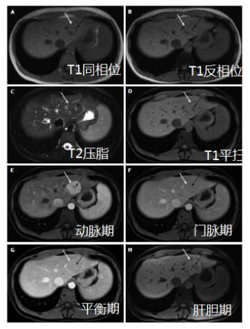 快速入门手册——肝脏占位MRI 快速入门手册——肝脏占位MRI