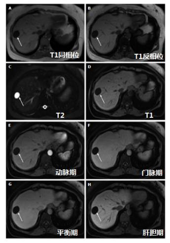 快速入门手册——肝脏占位MRI 快速入门手册——肝脏占位MRI