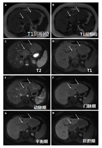 快速入门手册——肝脏占位MRI 快速入门手册——肝脏占位MRI