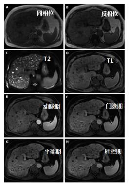 快速入门手册——肝脏占位MRI 快速入门手册——肝脏占位MRI
