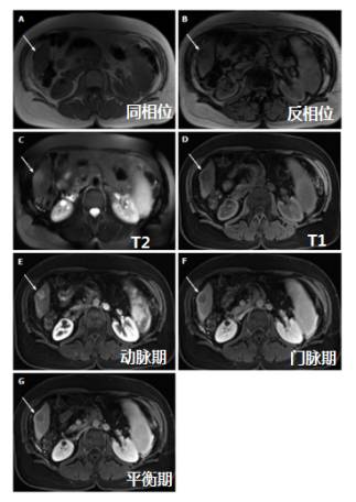 快速入门手册——肝脏占位MRI 快速入门手册——肝脏占位MRI