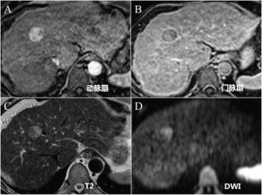 快速入门手册——肝脏占位MRI 快速入门手册——肝脏占位MRI