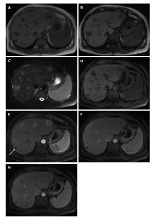 快速入门手册——肝脏占位MRI 快速入门手册——肝脏占位MRI
