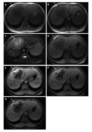 快速入门手册——肝脏占位MRI 快速入门手册——肝脏占位MRI