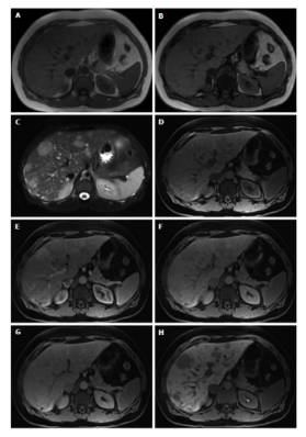 快速入门手册——肝脏占位MRI 快速入门手册——肝脏占位MRI