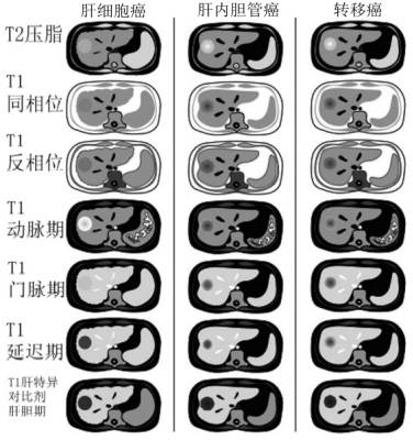 快速入门手册——肝脏占位MRI 快速入门手册——肝脏占位MRI