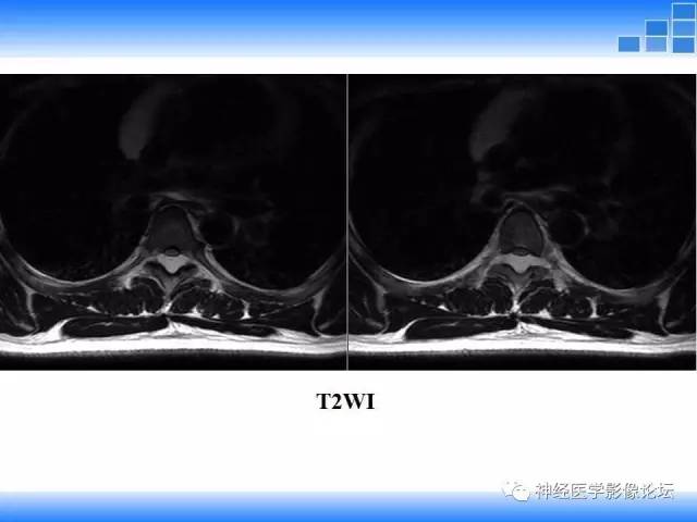 【病例】胸椎椎管内硬膜外血管脂肪瘤1例MR