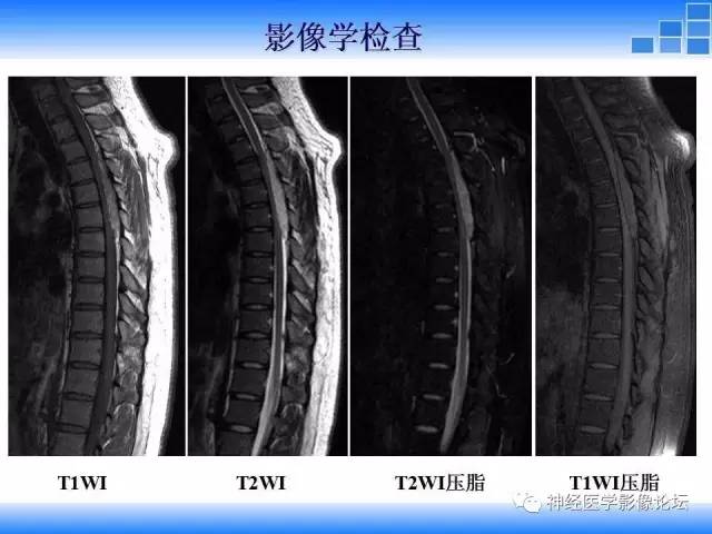 【病例】胸椎椎管内硬膜外血管脂肪瘤1例MR