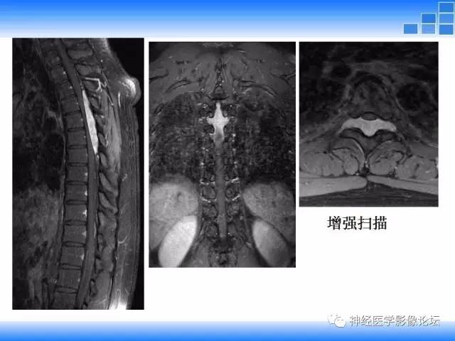 【病例】胸椎椎管内硬膜外血管脂肪瘤1例MR
