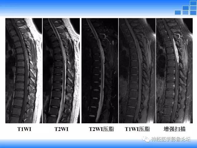 【病例】胸椎椎管内硬膜外血管脂肪瘤1例MR