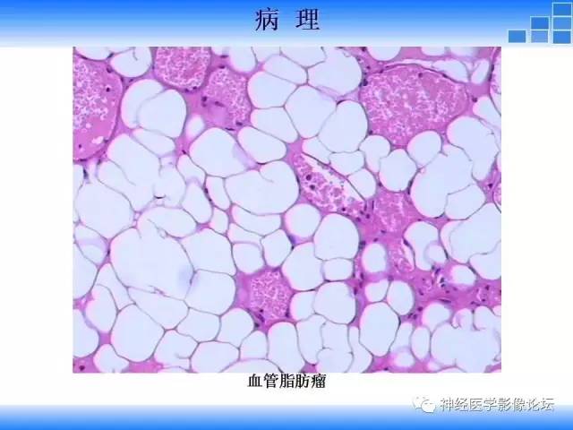 【病例】胸椎椎管内硬膜外血管脂肪瘤1例MR