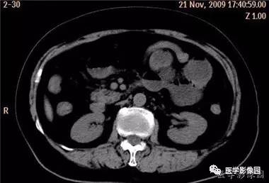 【病例】柿石引起的肠梗阻1例CT 【病例】柿石引起的肠梗阻1例CT