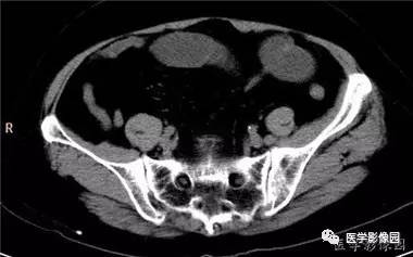 【病例】柿石引起的肠梗阻1例CT 【病例】柿石引起的肠梗阻1例CT