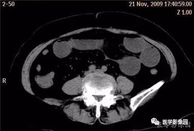 【病例】柿石引起的肠梗阻1例CT 【病例】柿石引起的肠梗阻1例CT