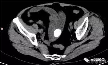 【病例】柿石引起的肠梗阻1例CT 【病例】柿石引起的肠梗阻1例CT